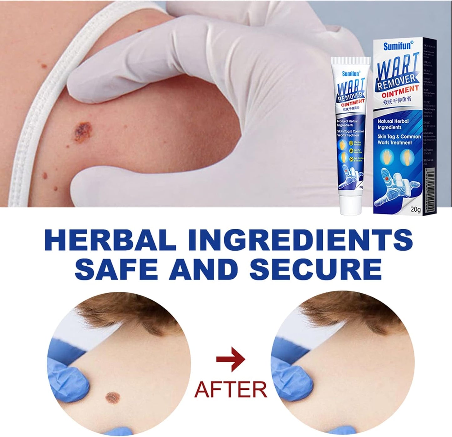Wart Remover Gel