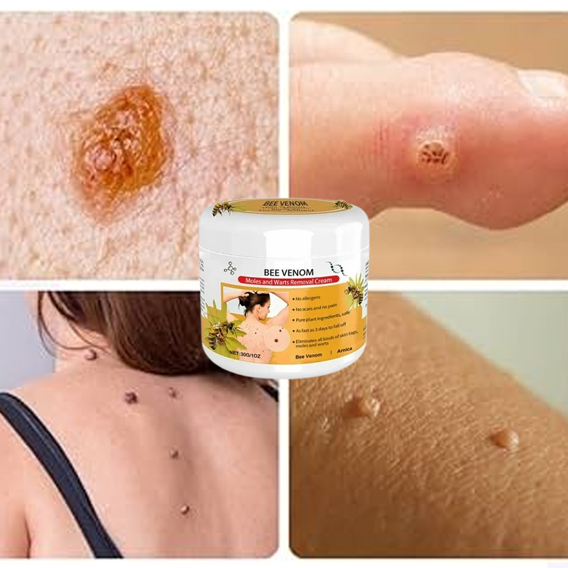 Warts Removal Cream