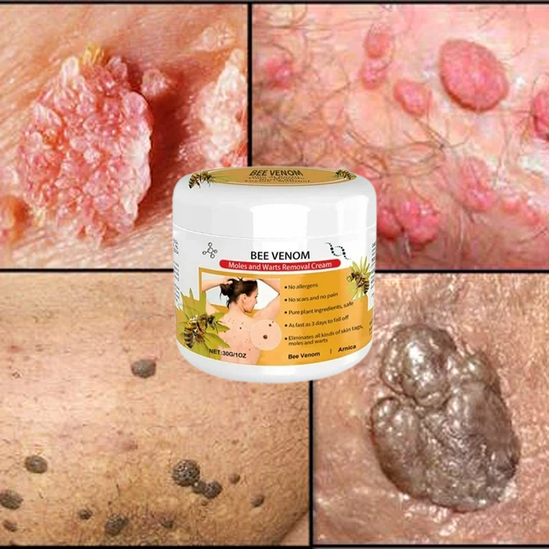 Warts Removal Cream 100% Natural